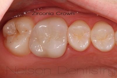 dental crown in missoula mt | nelson dentistry