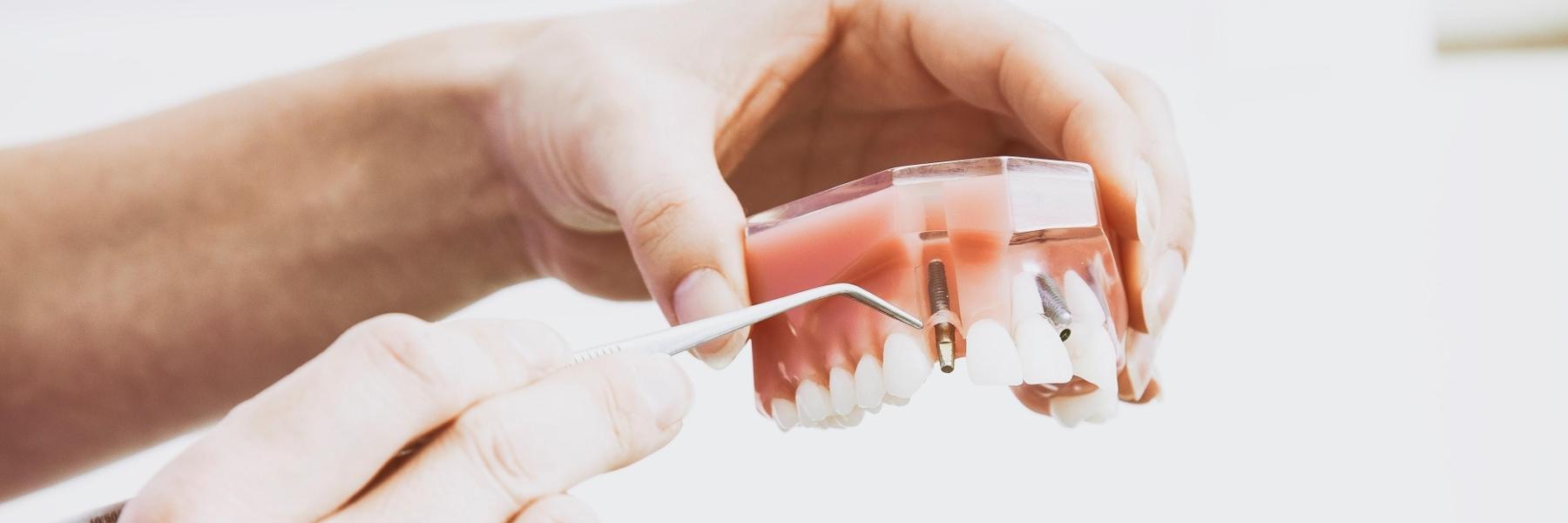 Model that shows how dental implants work in Missoula MT
