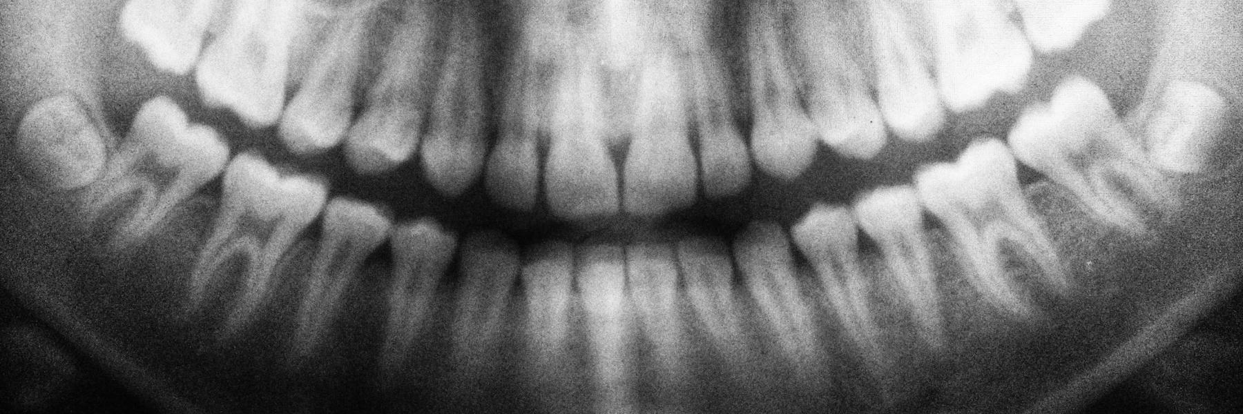 Nelson Dentistry jaw x ray in Missoula MT