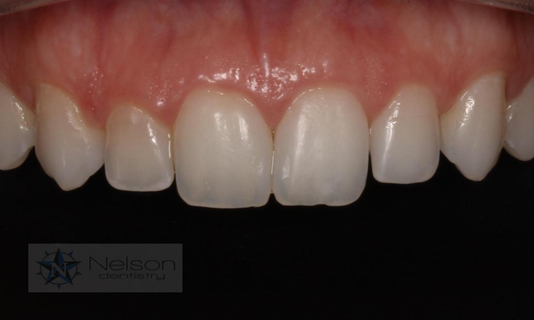 after composite bonding in missoula mt