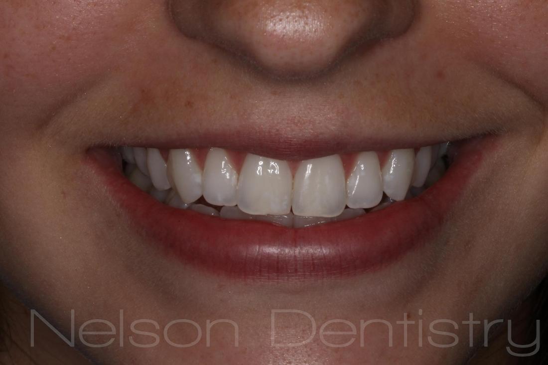 White Spot Removal in Missoula | Before & After