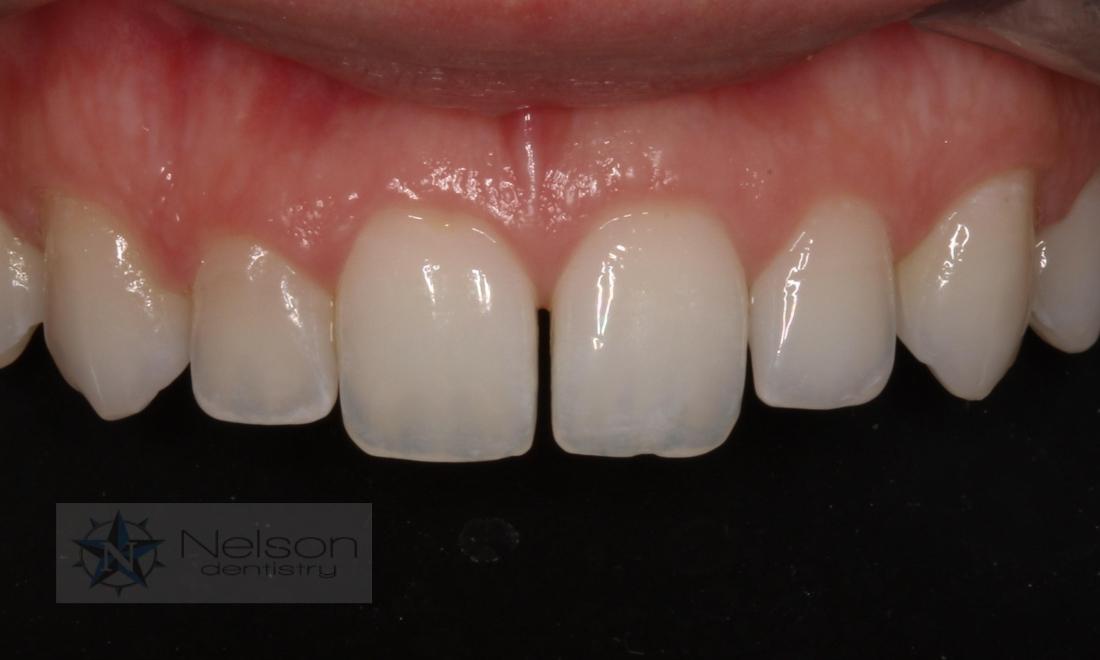 before composite bonding in missoula mt