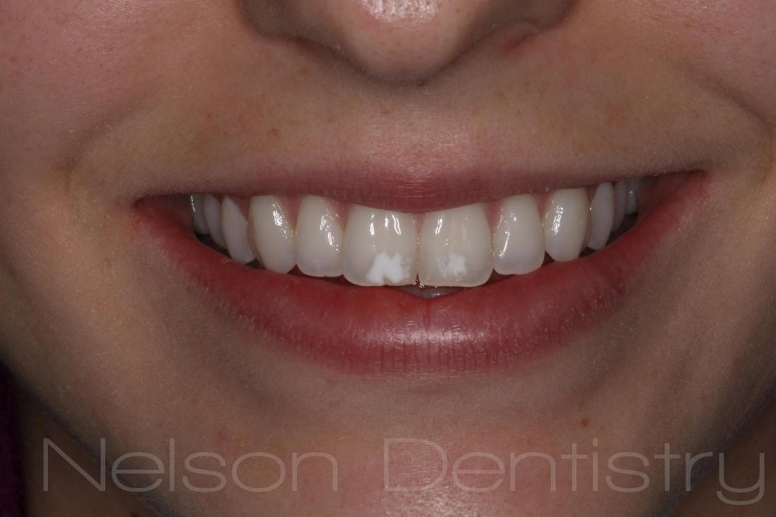 White Spot Removal in Missoula | Before & After
